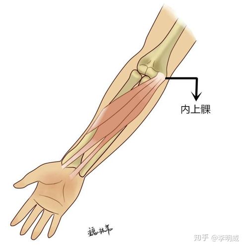 高尔夫球肘是自限性疾病吗？