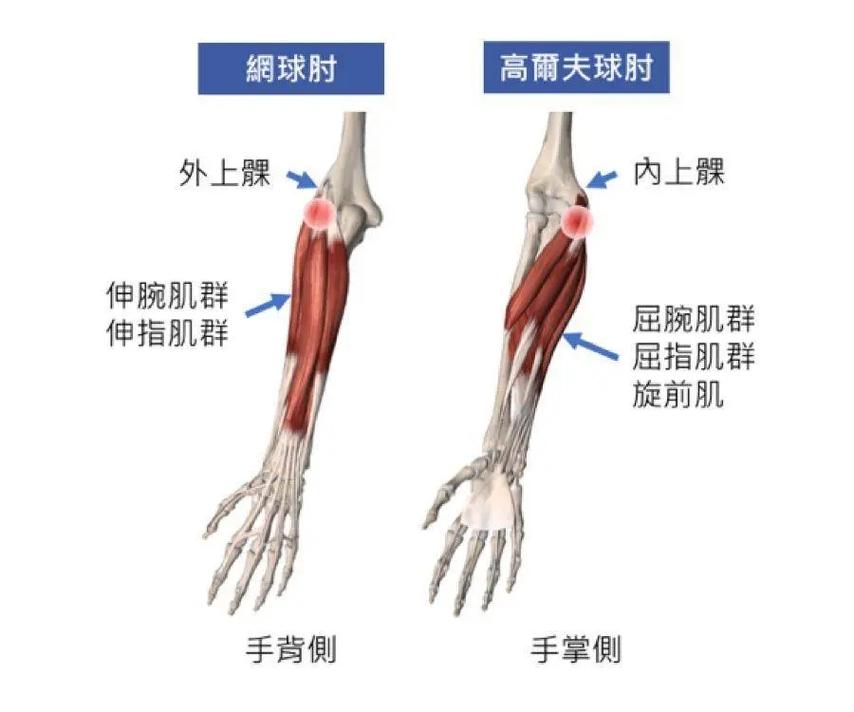 高尔夫球肘的临床表现