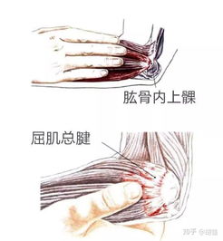 高尔夫球肘发生的原因是什么